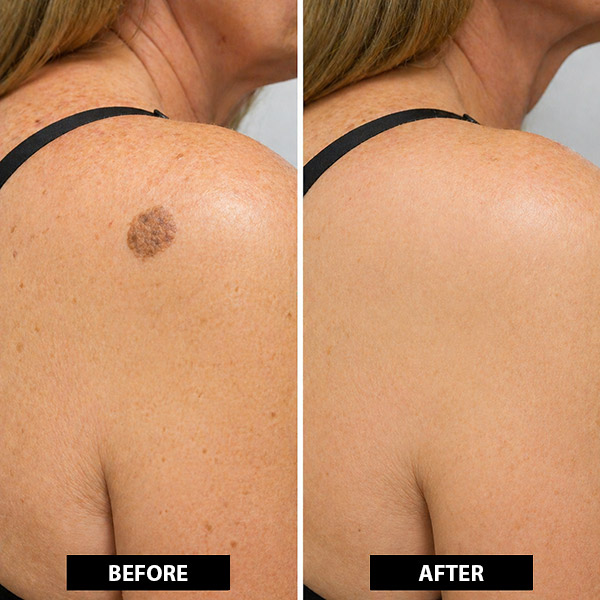 BEFORE AFTER 1